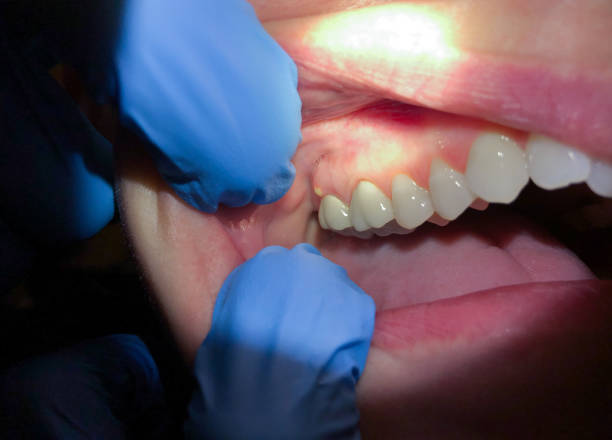 Best Emergency Dental Care for Abscessed Tooth in Walters, OK